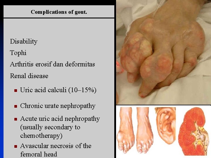 Complications of gout. Disability Tophi Arthritis erosif dan deformitas Renal disease n Uric acid