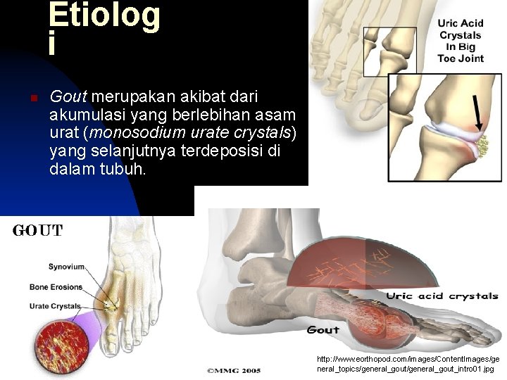 Etiolog i n Gout merupakan akibat dari akumulasi yang berlebihan asam urat (monosodium urate