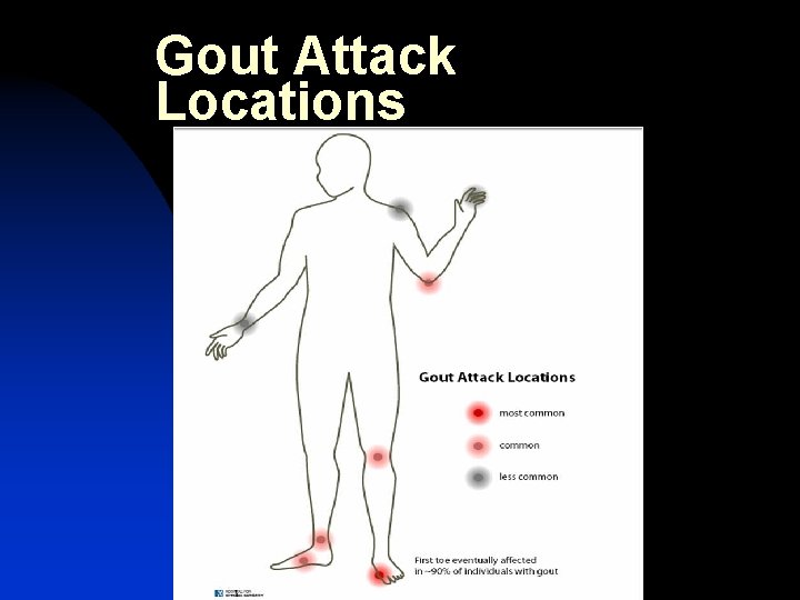 Gout Attack Locations 