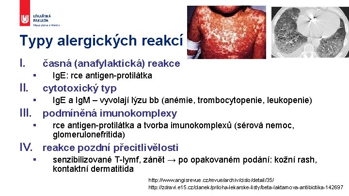 Typy alergických reakcí I. časná (anafylaktická) reakce § II. Ig. E: rce antigen-protilátka cytotoxický