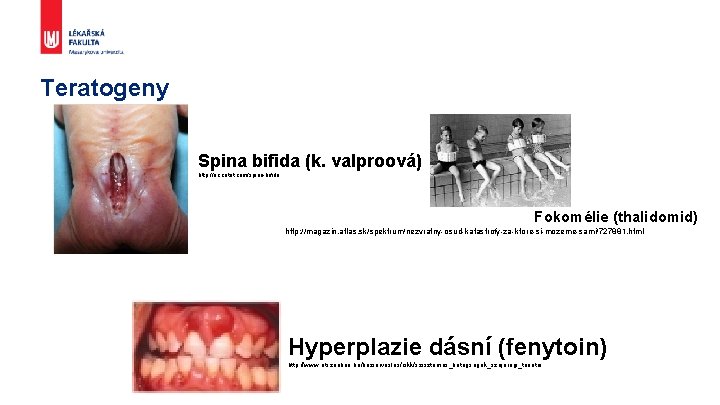 Teratogeny Spina bifida (k. valproová) http: //ec. cotot. com/spina-bifida Fokomélie (thalidomid) http: //magazin. atlas.