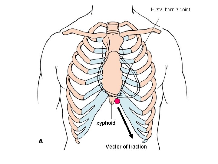 Hiatal hernia point xyphoid Vector of traction 