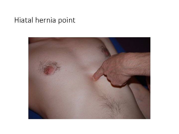 Hiatal hernia point 
