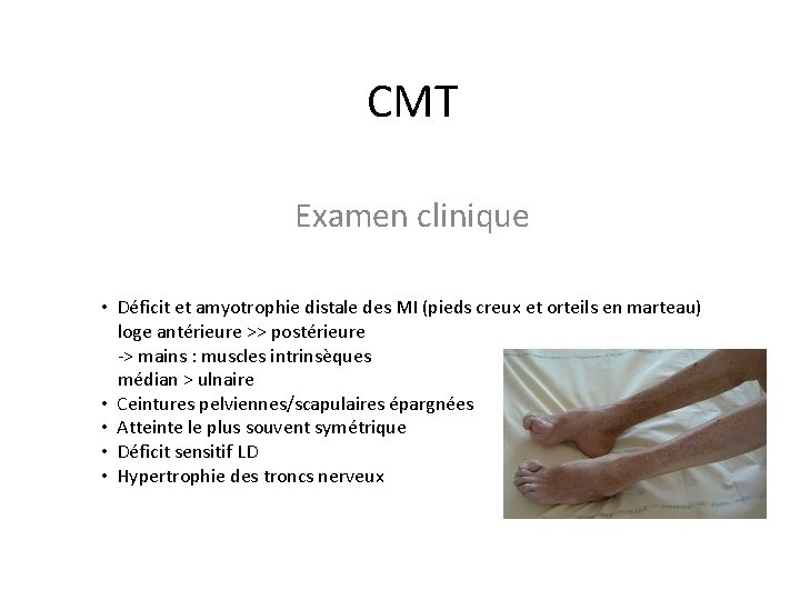 CMT Examen clinique • Déficit et amyotrophie distale des MI (pieds creux et orteils