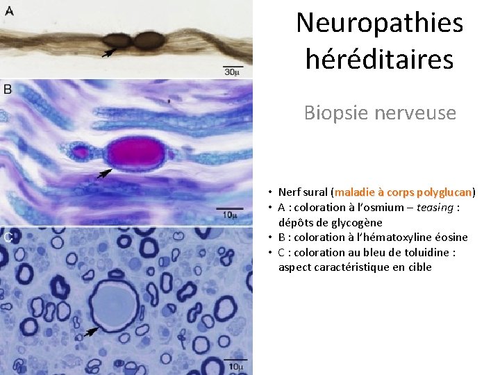 Neuropathies héréditaires Biopsie nerveuse • Nerf sural (maladie à corps polyglucan) polyglucan • A