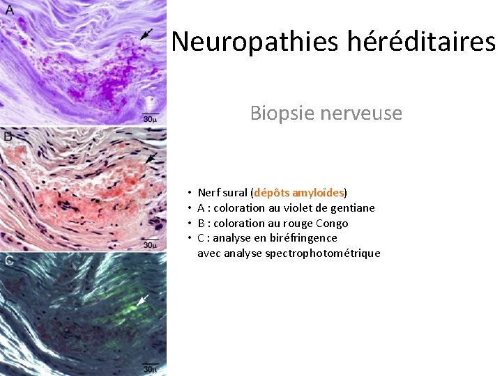 Neuropathies héréditaires Biopsie nerveuse • • Nerf sural (dépôts amyloïdes) amyloïdes A : coloration