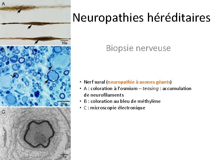 Neuropathies héréditaires Biopsie nerveuse • Nerf sural (neuropathie à axones géants) géants • A