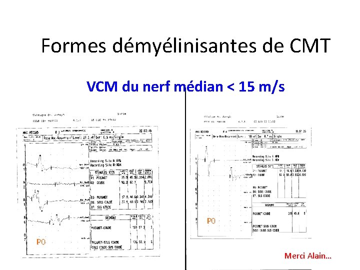 Formes démyélinisantes de CMT VCM du nerf médian < 15 m/s P 0 Merci