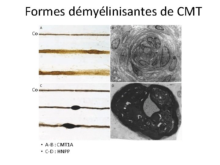 Formes démyélinisantes de CMT Co Biopsie nerveuse Co • A-B : CMT 1 A