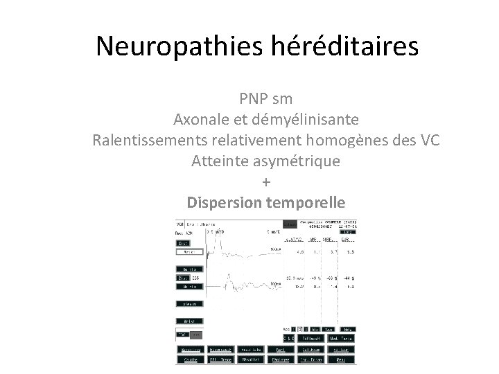 Neuropathies héréditaires PNP sm Axonale et démyélinisante Ralentissements relativement homogènes des VC Atteinte asymétrique