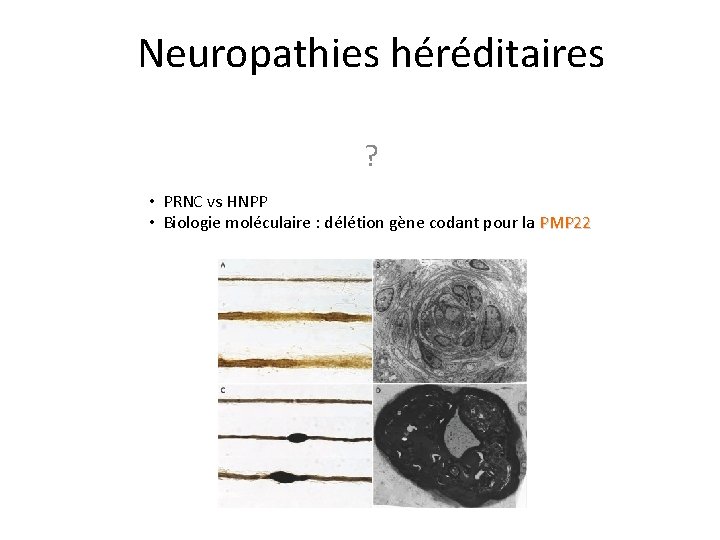 Neuropathies héréditaires ? • PRNC vs HNPP • Biologie moléculaire : délétion gène codant