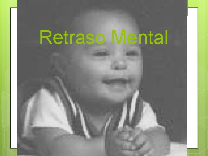 Retraso Mental 