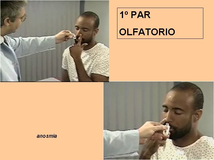 1º PAR OLFATORIO anosmia 