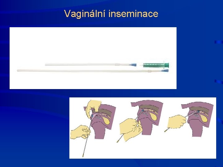 Vaginální inseminace 