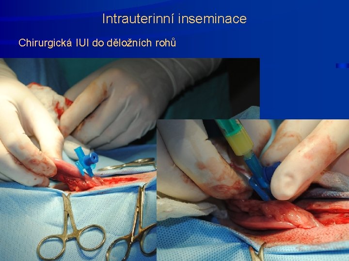 Intrauterinní inseminace Chirurgická IUI do děložních rohů 