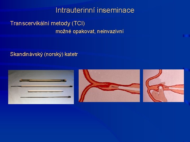 Intrauterinní inseminace Transcervikální metody (TCI) možné opakovat, neinvazivní Skandinávský (norský) katetr 