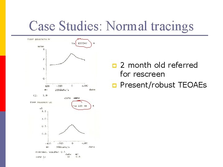 Case Studies: Normal tracings p p 2 month old referred for rescreen Present/robust TEOAEs