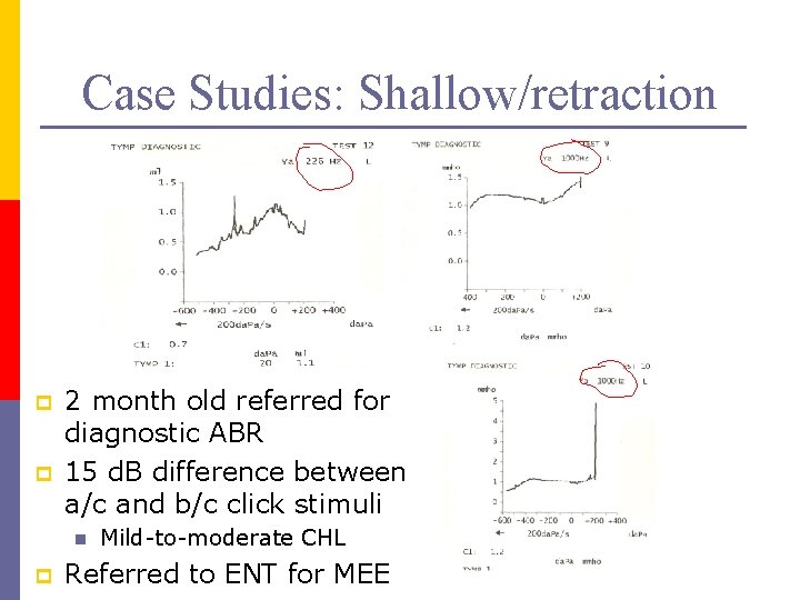 Case Studies: Shallow/retraction p p 2 month old referred for diagnostic ABR 15 d.