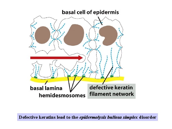 Defective keratins lead to the epidermolysis bullosa simplex disorder 