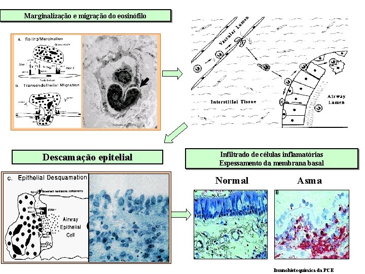 Marginalização e migração do eosinófilo Fukuda et al 1996 Descamação epitelial Infiltrado de células