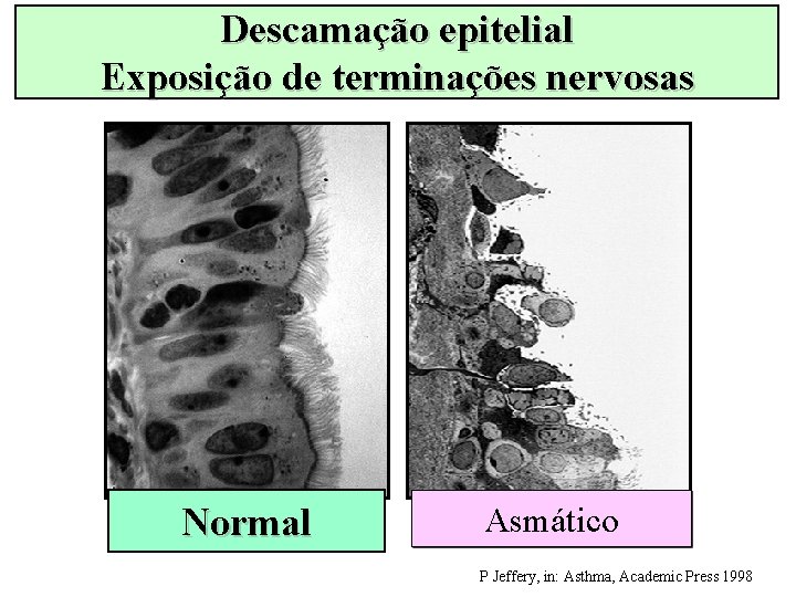 Descamação epitelial Exposição de terminações nervosas Normal Asmático P Jeffery, in: Asthma, Academic Press