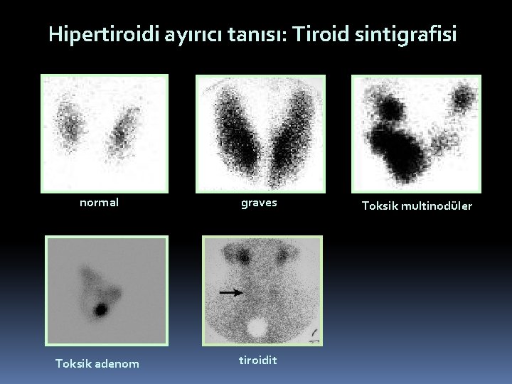 Hipertiroidi ayırıcı tanısı: Tiroid sintigrafisi normal graves Toksik adenom tiroidit Toksik multinodüler 