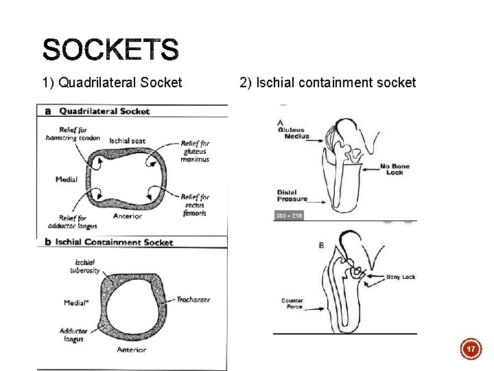 1) Quadrilateral Socket 2) Ischial containment socket 17 