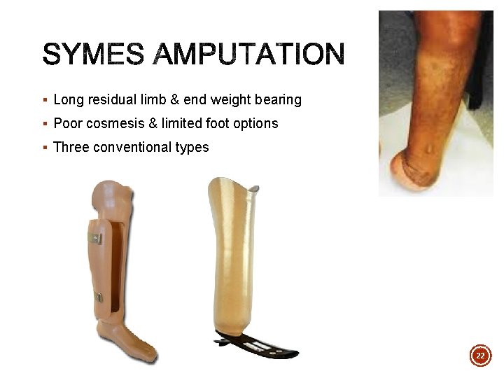 § Long residual limb & end weight bearing § Poor cosmesis & limited foot