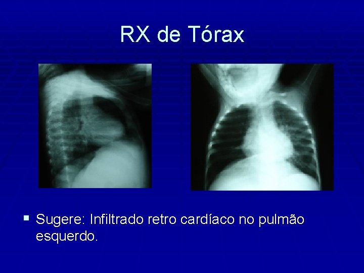 RX de Tórax § Sugere: Infiltrado retro cardíaco no pulmão esquerdo. 