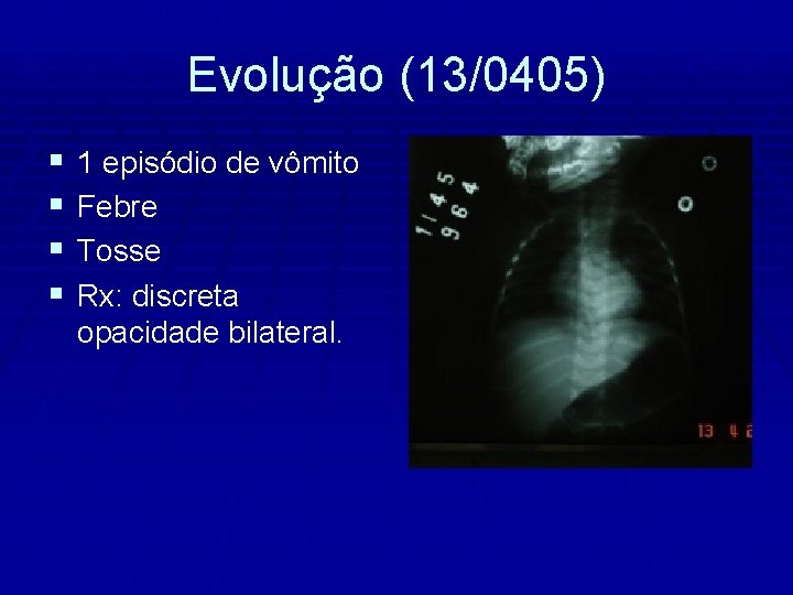 Evolução (13/0405) § § 1 episódio de vômito Febre Tosse Rx: discreta opacidade bilateral.