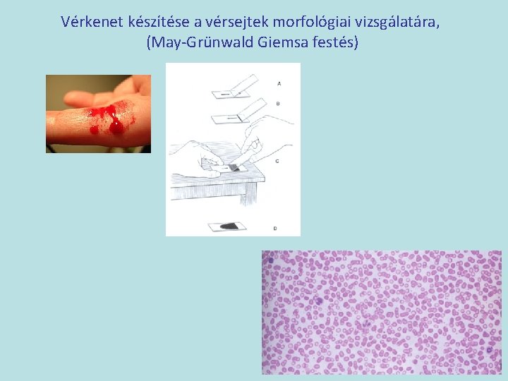 Vérkenet készítése a vérsejtek morfológiai vizsgálatára, (May-Grünwald Giemsa festés) 