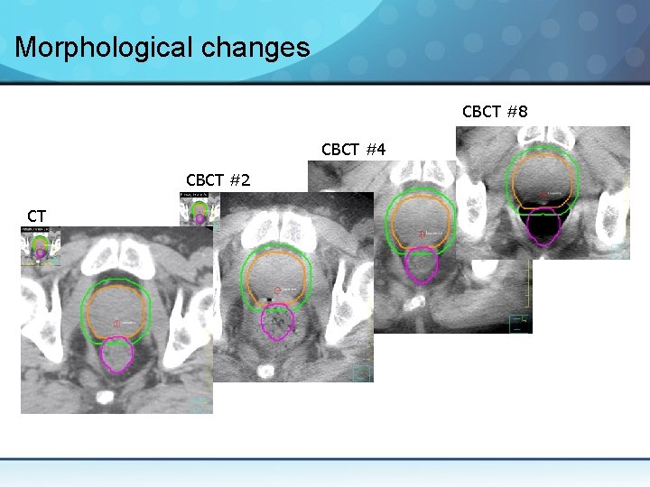 Morphological changes CBCT #8 CBCT #4 CBCT #2 CT 
