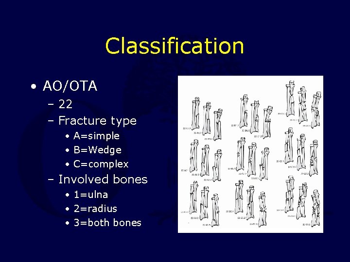 Classification • AO/OTA – 22 – Fracture type • A=simple • B=Wedge • C=complex