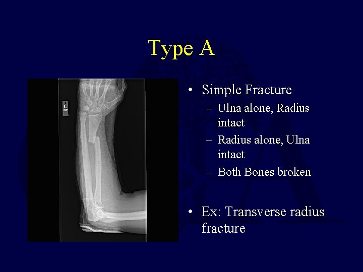 Type A • Simple Fracture – Ulna alone, Radius intact – Radius alone, Ulna