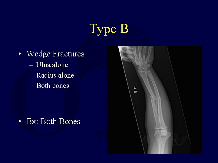 Type B • Wedge Fractures – Ulna alone – Radius alone – Both bones