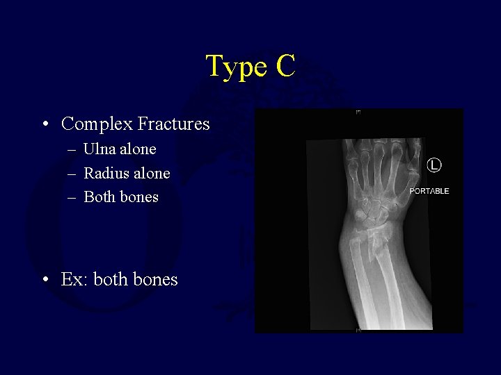 Type C • Complex Fractures – Ulna alone – Radius alone – Both bones