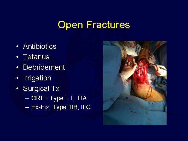 Open Fractures • • • Antibiotics Tetanus Debridement Irrigation Surgical Tx – ORIF: Type