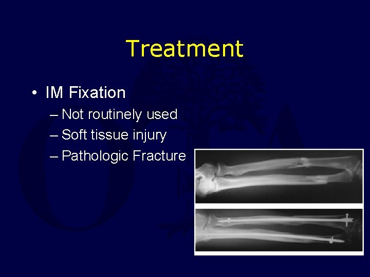 Treatment • IM Fixation – Not routinely used – Soft tissue injury – Pathologic