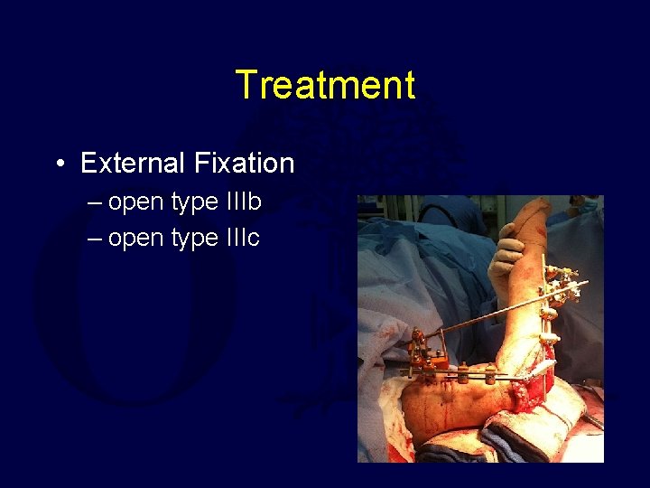 Treatment • External Fixation – open type IIIb – open type IIIc 