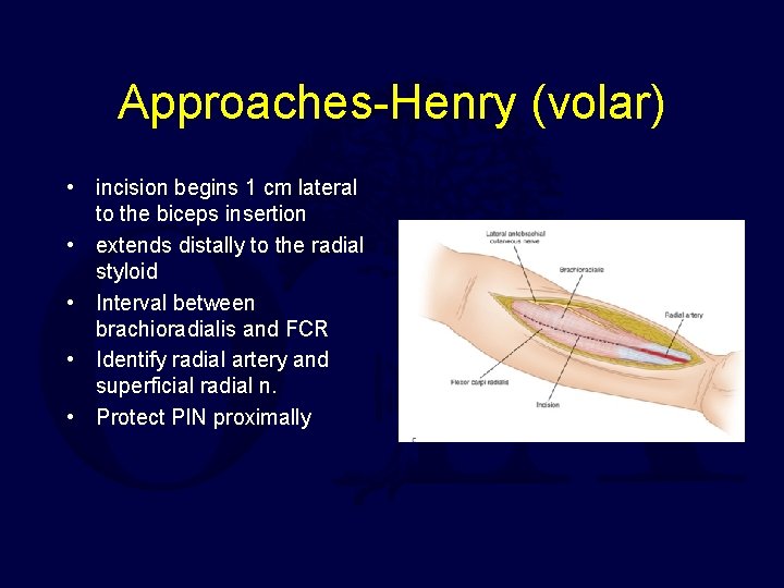 Approaches-Henry (volar) • incision begins 1 cm lateral to the biceps insertion • extends