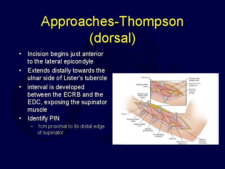 Approaches-Thompson (dorsal) • Incision begins just anterior to the lateral epicondyle • Extends distally