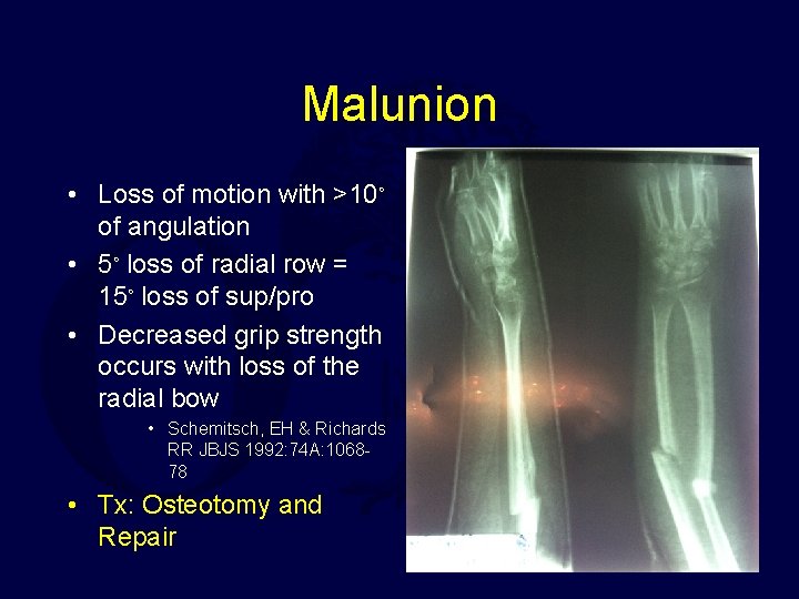 Malunion • Loss of motion with >10◦ of angulation • 5◦ loss of radial
