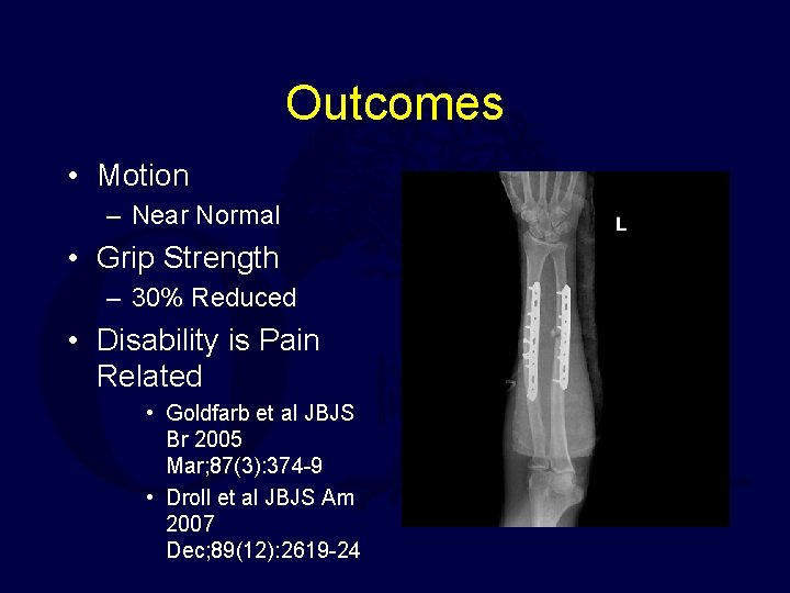 Outcomes • Motion – Near Normal • Grip Strength – 30% Reduced • Disability