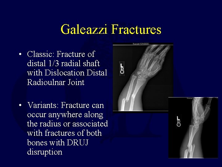 Galeazzi Fractures • Classic: Fracture of distal 1/3 radial shaft with Dislocation Distal Radioulnar