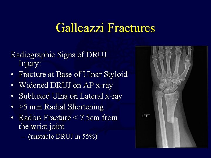 Galleazzi Fractures Radiographic Signs of DRUJ Injury: • Fracture at Base of Ulnar Styloid