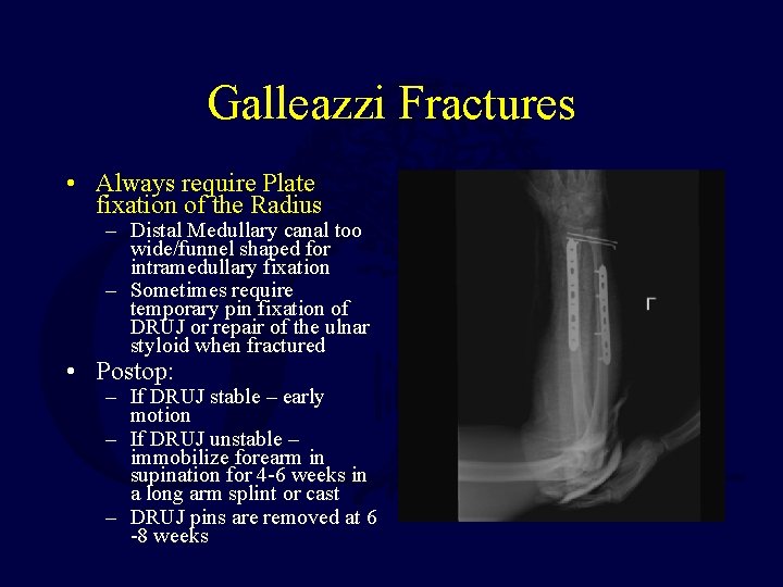 Galleazzi Fractures • Always require Plate fixation of the Radius – Distal Medullary canal