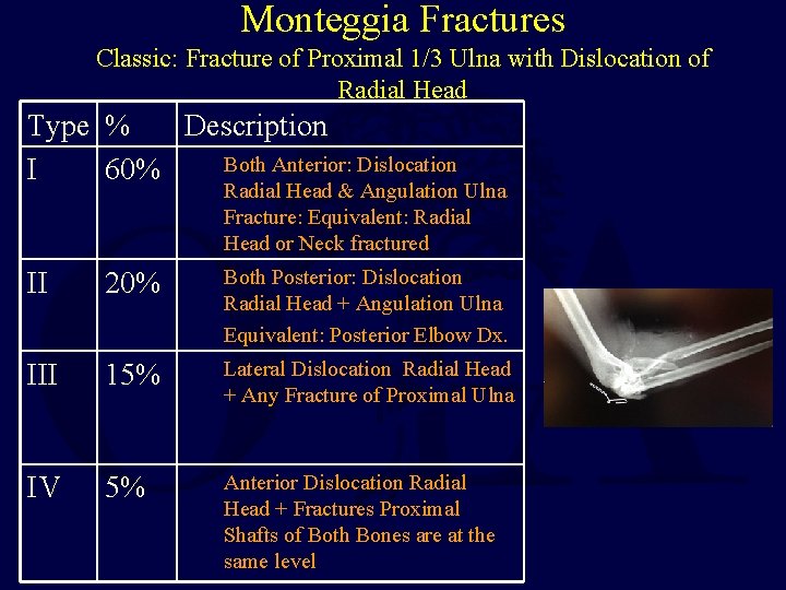 Monteggia Fractures Classic: Fracture of Proximal 1/3 Ulna with Dislocation of Radial Head Type