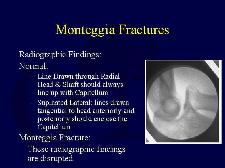 Monteggia Fractures Radiographic Findings: Normal: – Line Drawn through Radial Head & Shaft should