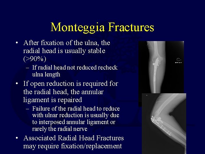 Monteggia Fractures • After fixation of the ulna, the radial head is usually stable