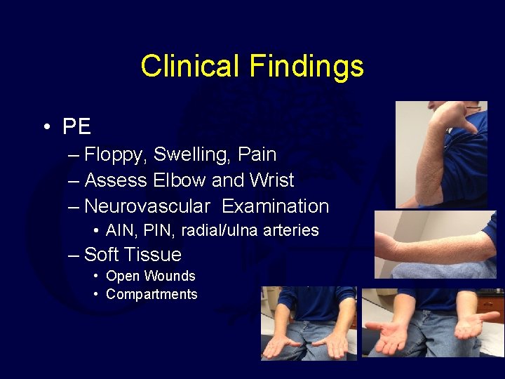 Clinical Findings • PE – Floppy, Swelling, Pain – Assess Elbow and Wrist –